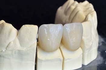 Ceramic Crowns in Santa Clara