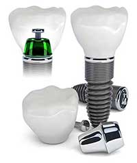 Dental implants in Santa Clara