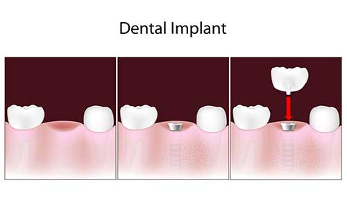 Implant Dentist in Santa Clara