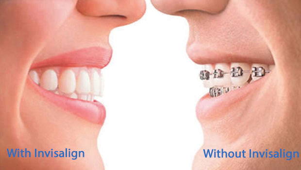 Invisalign in Santa Clara