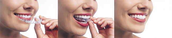 Santa Clara Invisalign