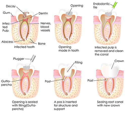 Root Canal in Santa Clara